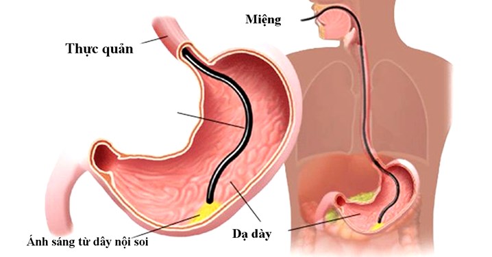 Tác dụng phụ và rủi ro khi nội soi dạ dày quá nhiều