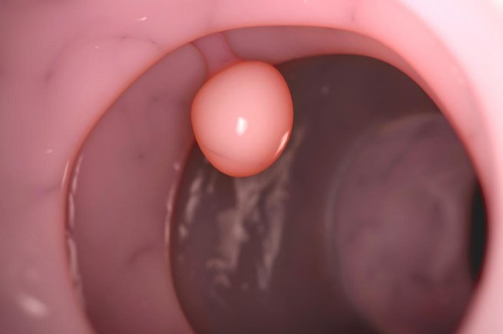 polyp dạ dày, nội soi dạ dày, polyp dạ dày là bệnh gì, polyp dạ dày ác tính