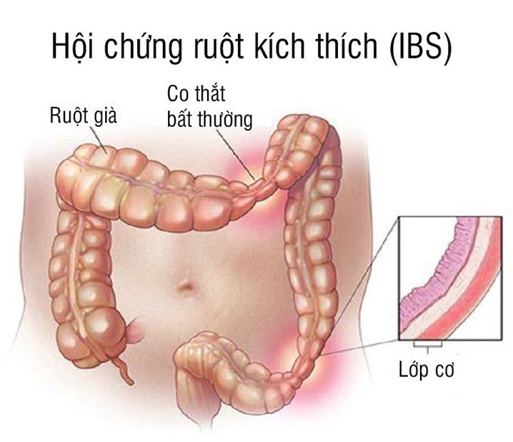 Những Thực Phẩm Nên Ăn Khi Mắc Hội Chứng Ruột Kích Thích