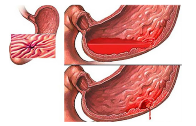 Xuất huyết tiêu hóa