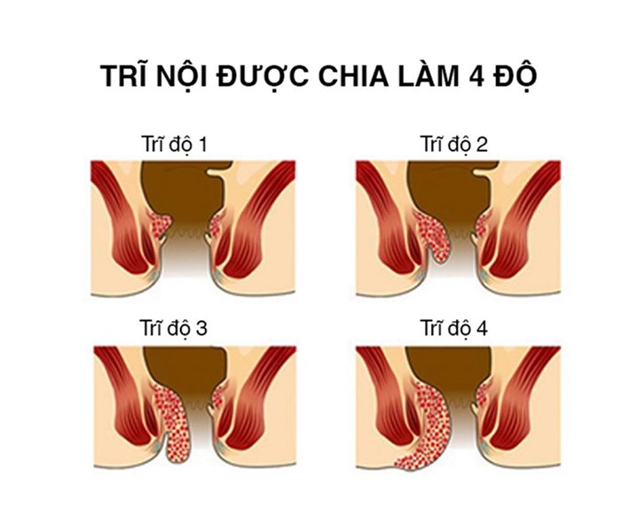 trĩ nội là  gì, giai đoạn của trĩ nội, trĩ nội độ 1, trĩ nội độ 2, trĩ nội độ 3, trĩ nội độ 4