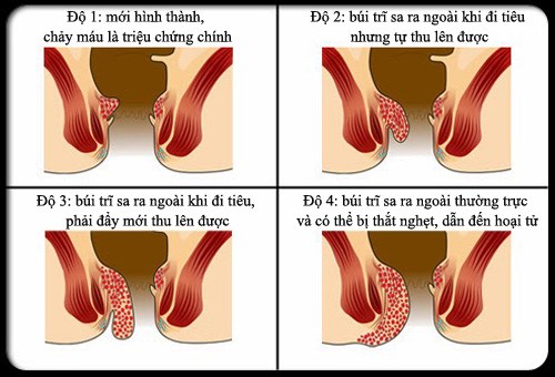 Bệnh Trĩ Nội  Triệu chứng của các giai đoạn và cách phòng tránh