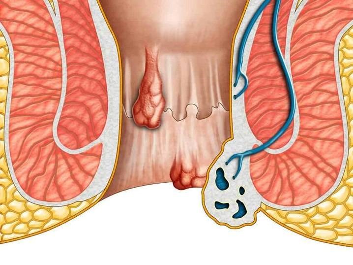 Bệnh trĩ là gì?