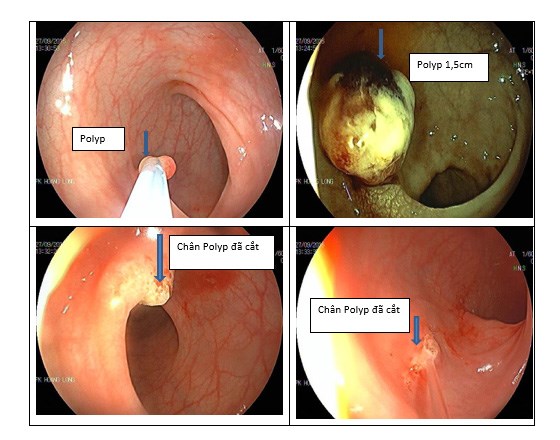 Hình ảnh nội soi đại tràng Laser của bệnh nhi 6 tuổi đi ngoài ra máu