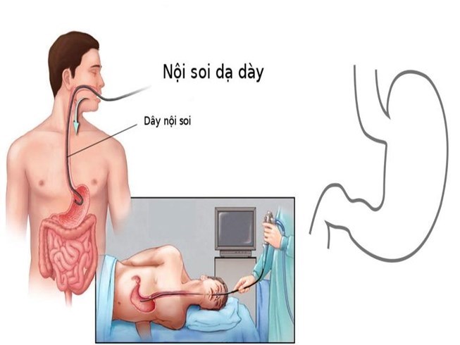 nội soi dạ dày, lưu ý trước khi nội soi dạ dày