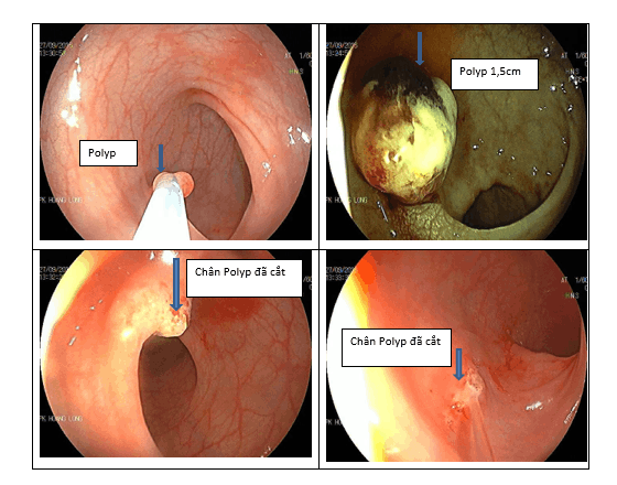 Trẻ đi ngoài ra máu, gia đình không ngờ 6 tuổi đã có polyp đại tràng