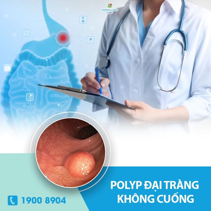 Polyp đại tràng không cuống