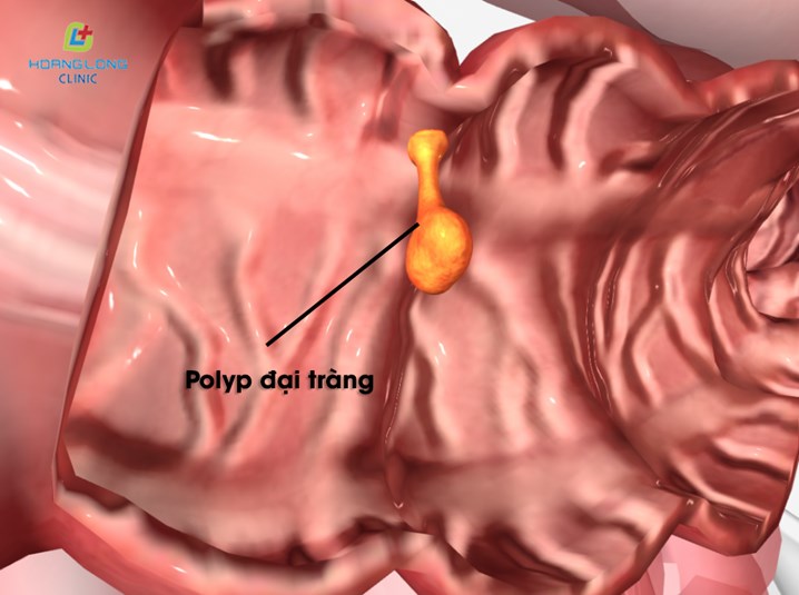 Polyp đại tràng