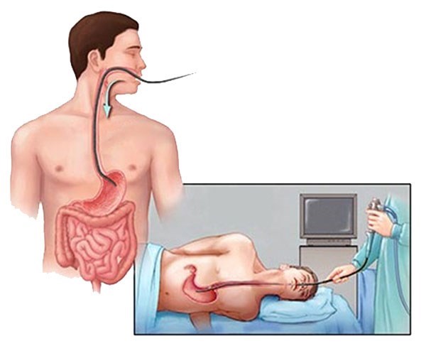 nội soi dạ dày, nội soi đại tràng, nội soi dạ dày và đại tràng giá bao nhiêu, nội soi tiền mê