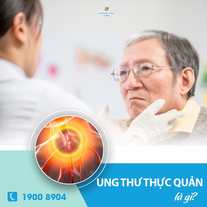 Ung thư thực quản là gì?