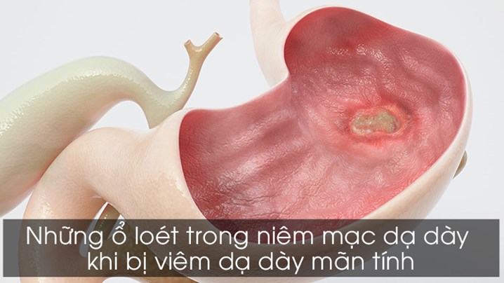 1. Giới thiệu tổng quan về viêm loét dạ dày mãn tính