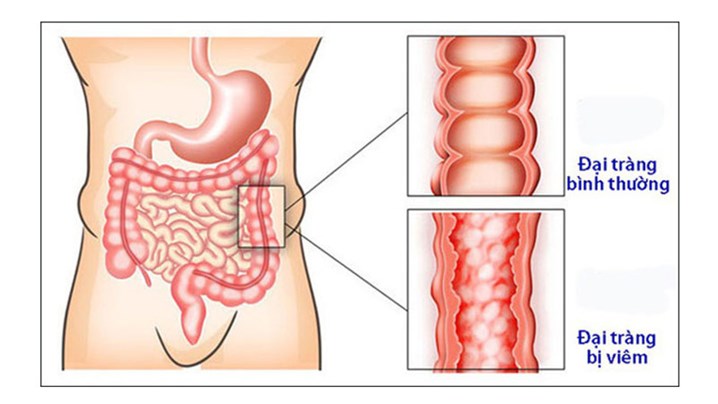 nội soi đại tràng, nội soi đại tràng có hại không, bao lâu nên nội soi một lần, nội soi đại tràng định kỳ