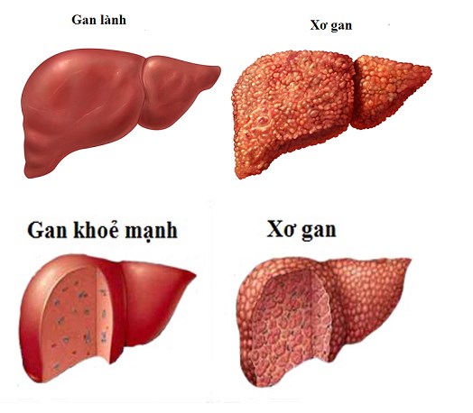 7. Câu Hỏi Thường Gặp về Xơ Gan