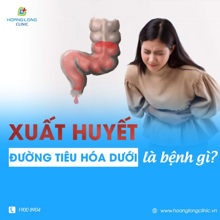 Xuất huyết đường tiêu hóa dưới