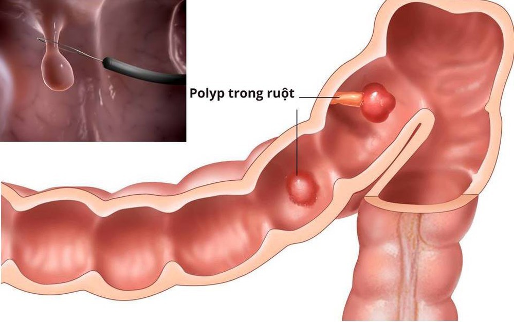 Polyp đại tràng có liên quan đến ung thư đại tràng không?
