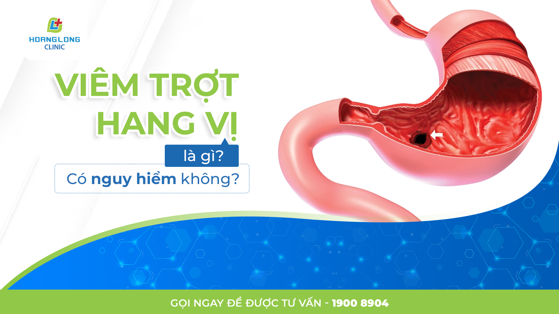 VIÊM TRỢT HANG VỊ LÀ GÌ? CÓ NGUY HIỂM HAY KHÔNG?