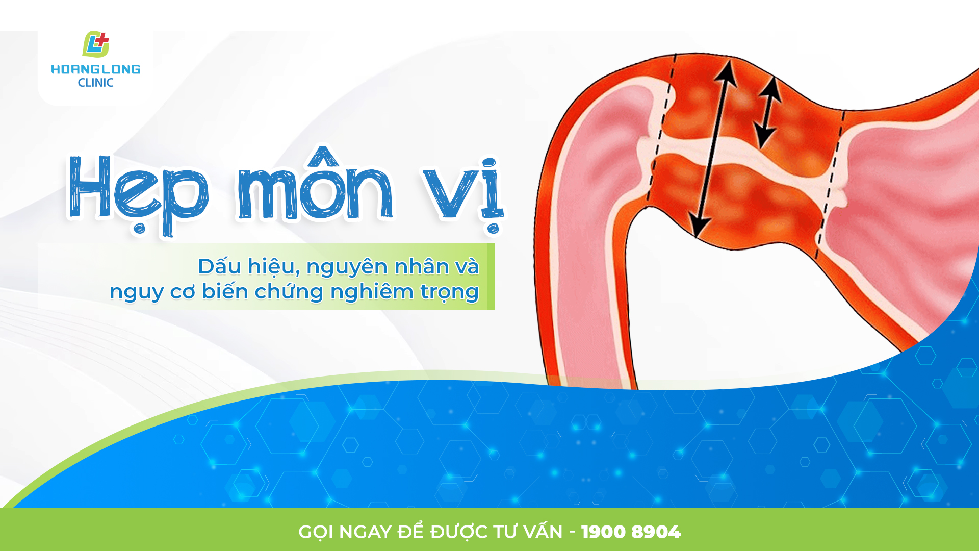 Hẹp môn vị: Dấu hiệu, nguyên nhân và biến chứng nguy hiểm cần biết