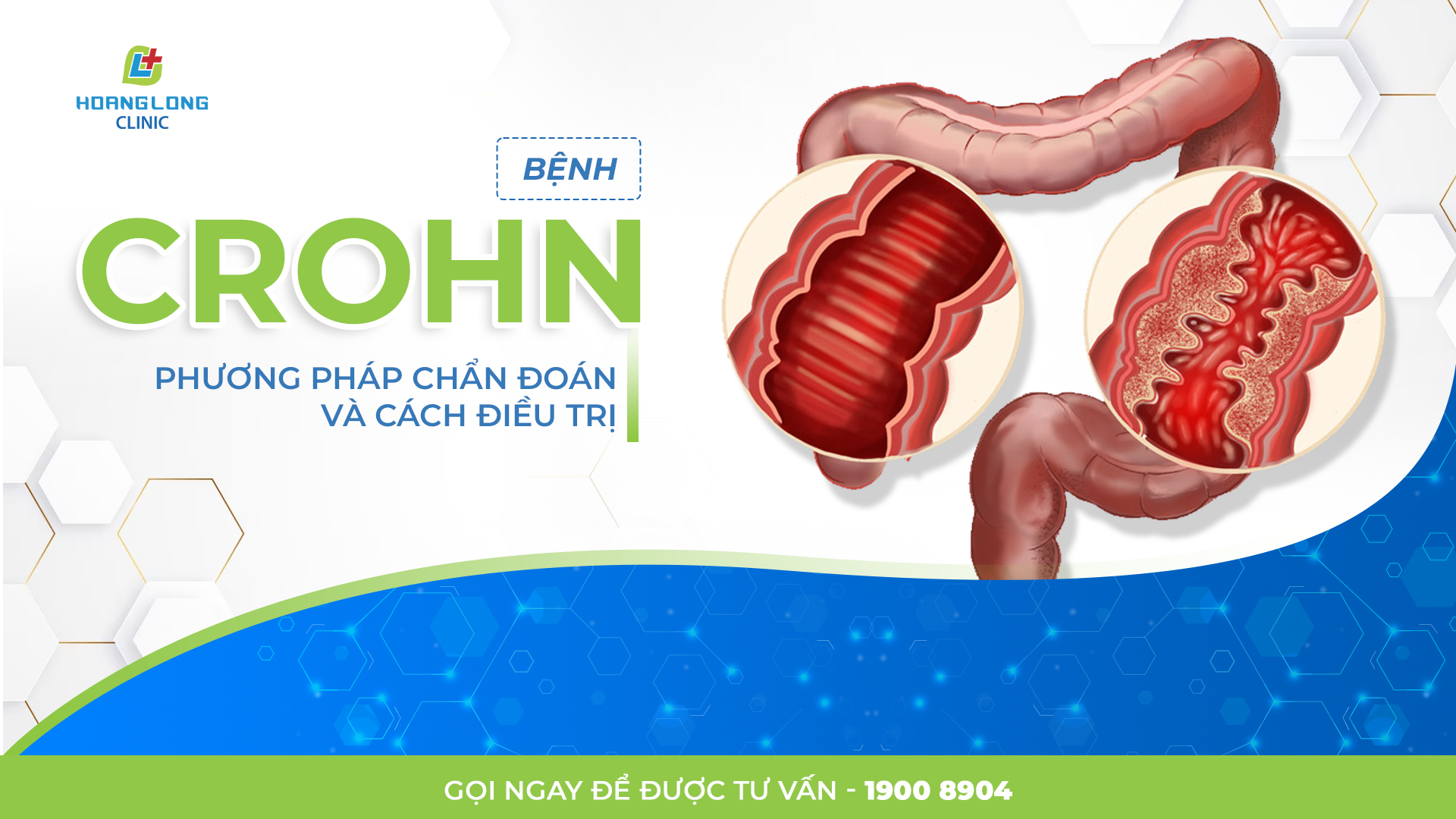 BỆNH CROHN: PHƯƠNG PHÁP CHẨN ĐOÁN VÀ CÁCH ĐIỀU TRỊ