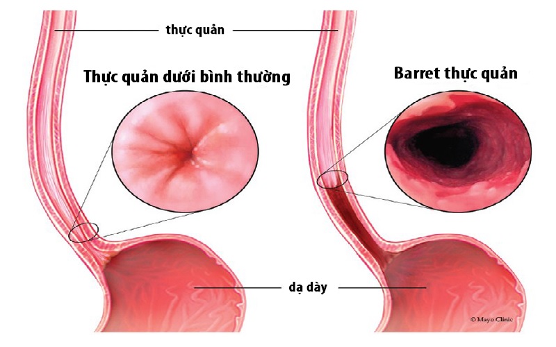 Barrett thực quản là bệnh gì và có đáng sợ như chúng ta tưởng?