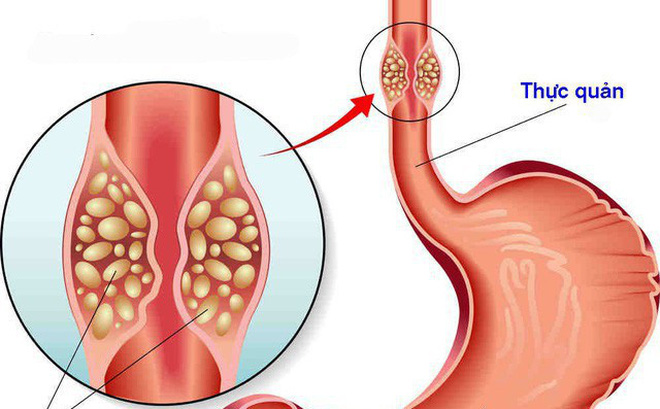 Thời gian sống trung bình của những người mắc ung thư thực quản di căn là bao lâu?
