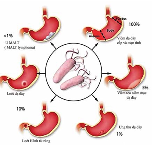 Có điều gì cần lưu ý khi điều trị và sử dụng thuốc cho đại tràng HP?
