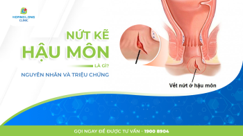 NỨT KẼ HẬU MÔN LÀ GÌ? NGUYÊN NHÂN VÀ TRIỆU CHỨNG